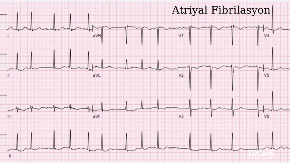 Atriyal Fibrilasyon görseli - DrCem hastalık rehberi